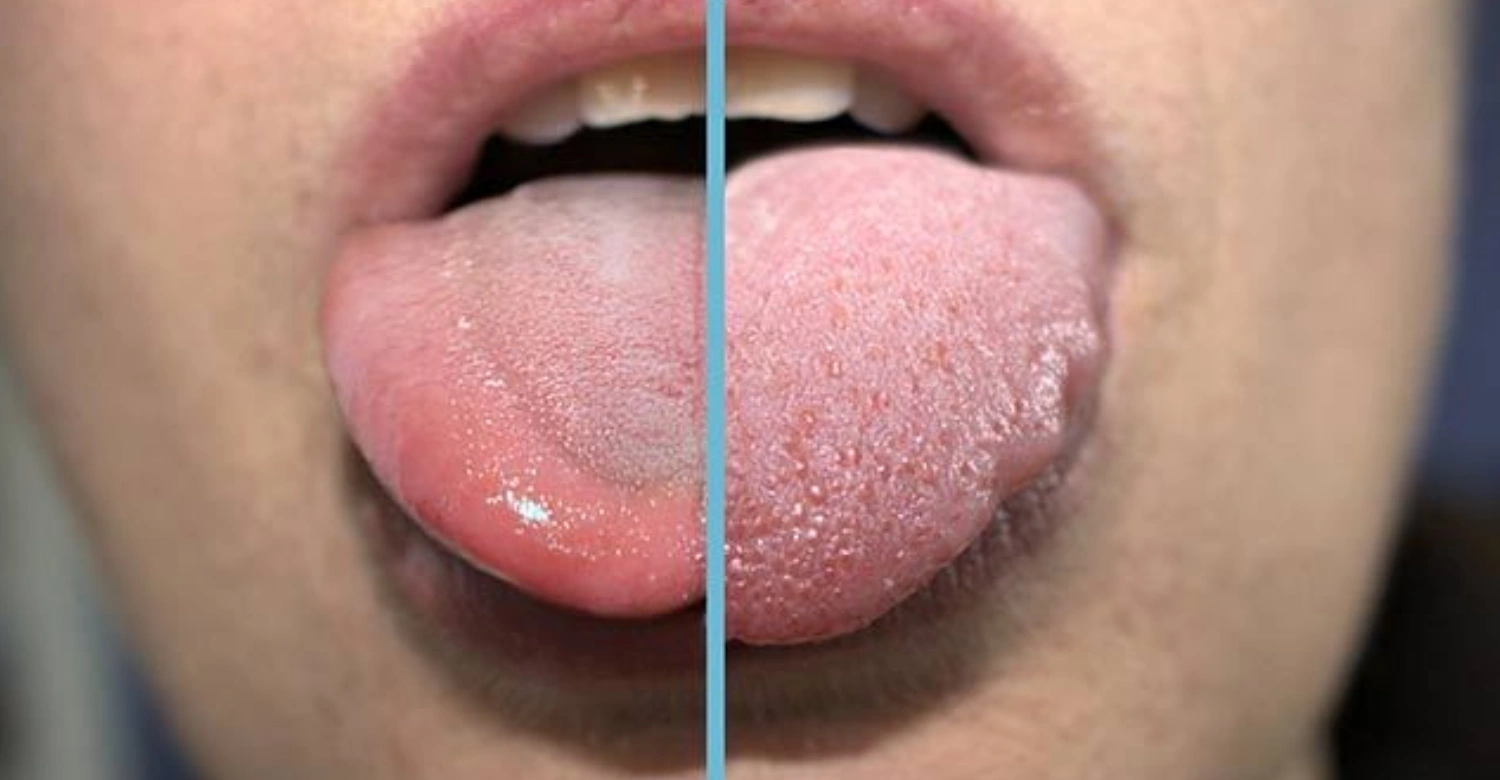 swollen tongue 2